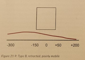 <ul><li><p>Retracted, poorly mobile.</p></li><li><p>Think: Middle ear effusion or perforated ear drum</p></li><li><p>Compliance curve is nearly flat to completely flat and always below normal.</p></li><li><p>Negative middle ear pressure (Peak compliance is shifted left)</p></li><li><p>Conductive hearing loss</p></li></ul>