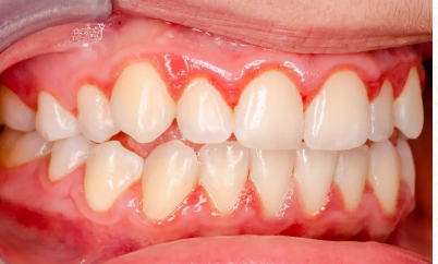 <p>inflammation of the gums</p>