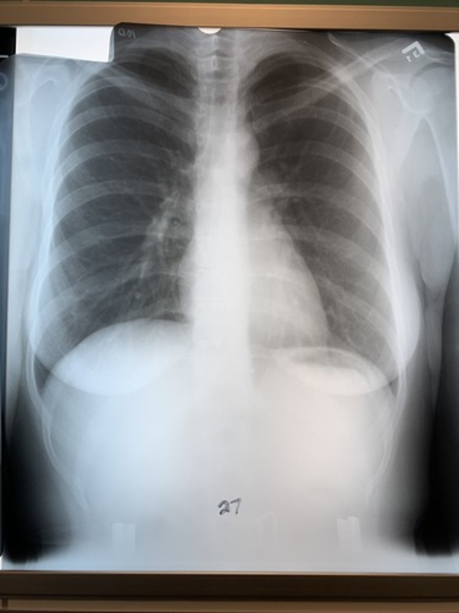 <p>Penetrated</p><p>1 multiple choice option</p>