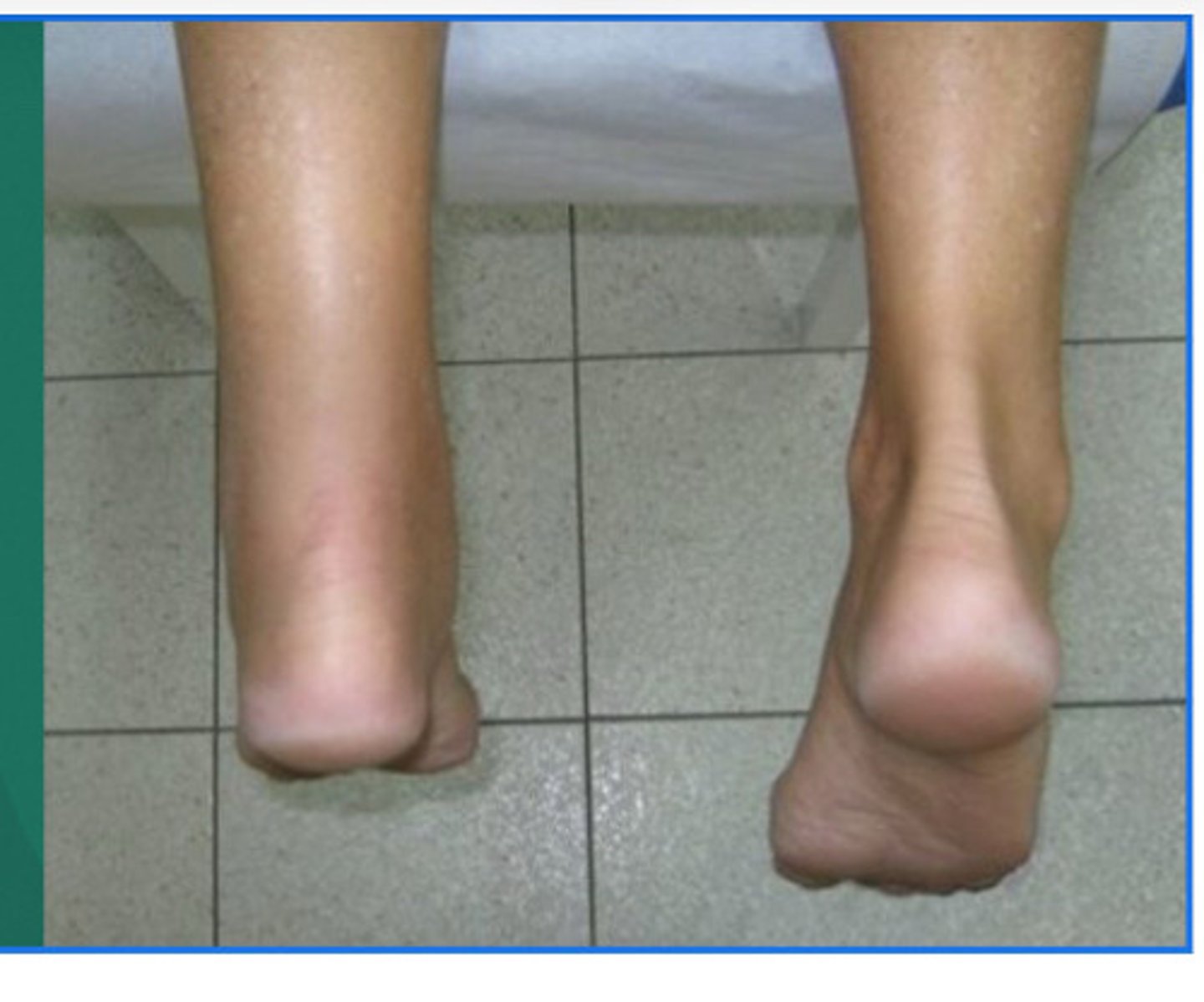 <p>• complete rupture of achilles tendon (commonly at 2-3 inc from calcaneus)</p><p>• Achilles tendon is the thickets tendon in the body</p><p>• sx: feeling of getting shot of kicked in the back of the leg, hearing a pop, pain unable to walk, swelling, deformity</p><p>• TX: splint, ice, crutches, refer to physician, surgical repair 4-6 month recovery</p>