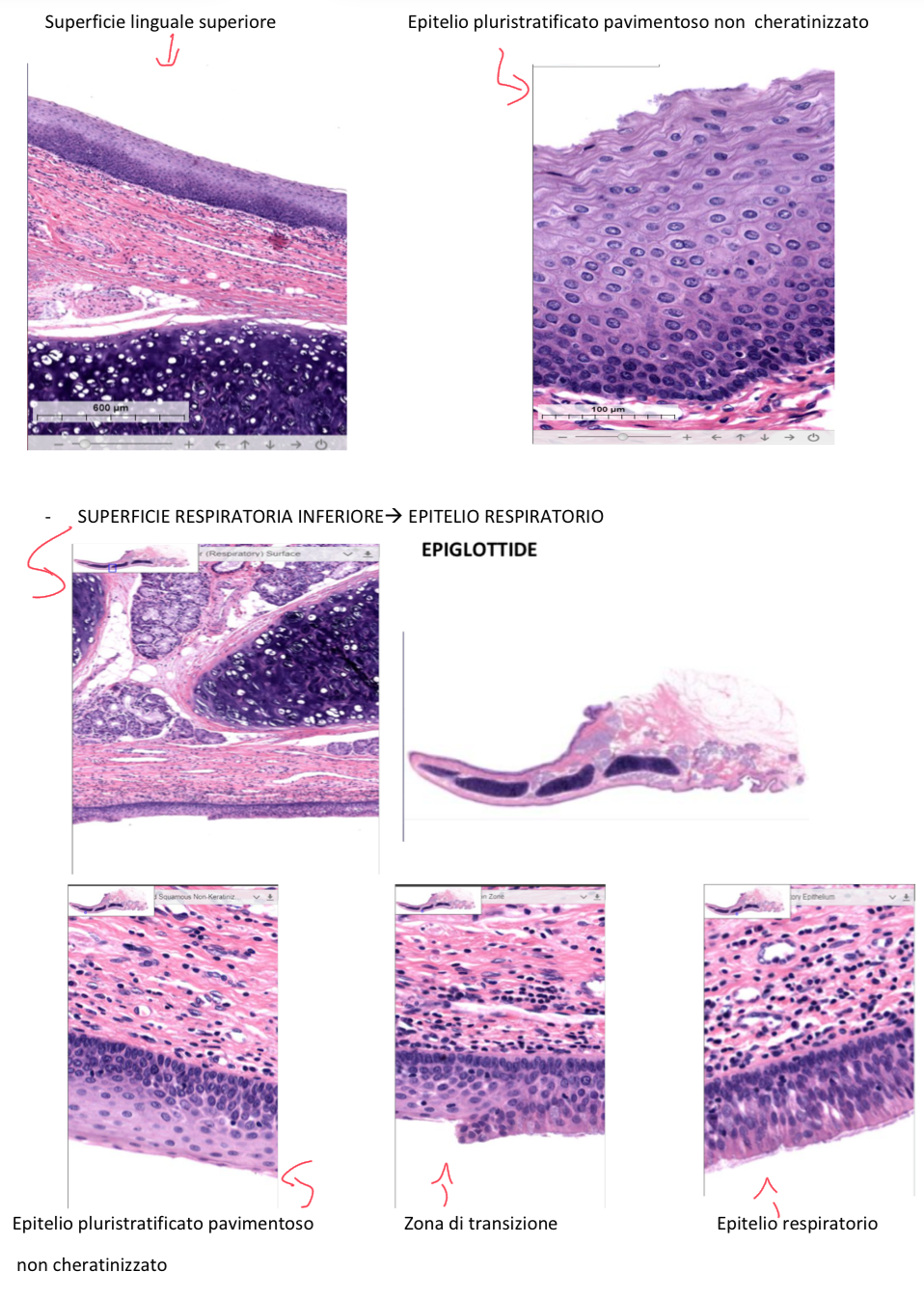 <p>Superficie Linguale Superiore:</p><ul><li><p>Rivolta verso la base della lingua</p></li><li><p>E’ rivestita da epitelio pluristratificato pavimentoso non cheratinizzato</p></li></ul><p>Superficie Respiratoria Inferiore:</p><ul><li><p>Superficie inferiore dell’epiglottide rivolta verso la cavità laringea</p></li><li><p>E’ rivestita da epitelio respiratorio</p></li><li><p>Però una sua porzione, cioè quella che sporge oltre l’adito quando l’epiglottide si chiude, è rivestita da epitelio pluristratificato pavimentoso non cheratinizzato poiché esposta al bolo</p></li></ul><p>Quindi le zone esposte all’aria sono epitelio respiratorio, mentre le zone esposte al bolo sono pavimentasse per maggiore protezione</p><p></p>