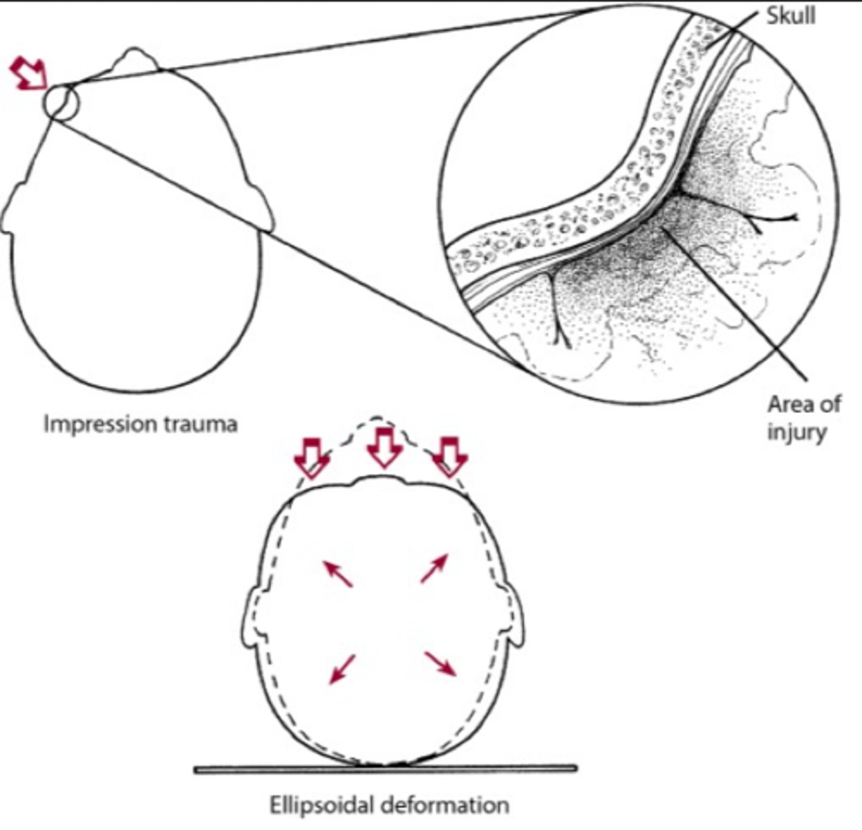 <p>-skull forced by object to more circular shape</p><p>-Expansion causes stretching and shearing of brain tissues and blood vessels</p>