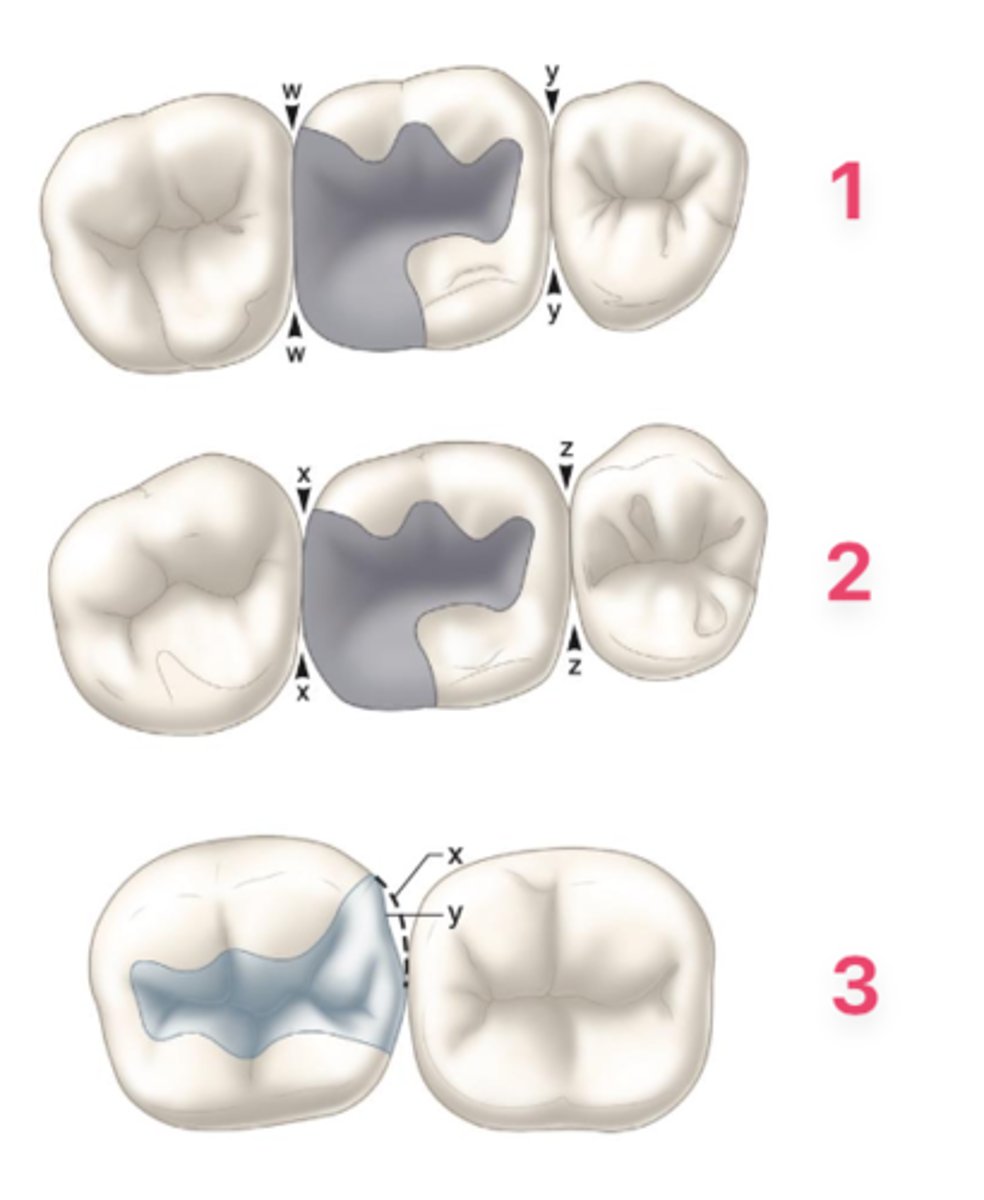 <p>How do these three restorations compare?</p>