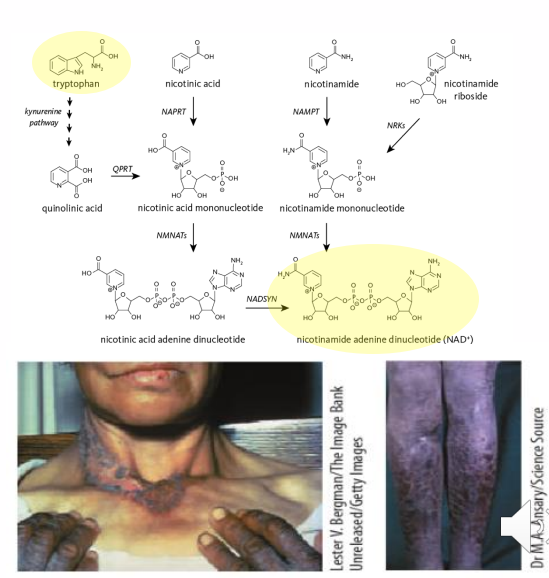 <p>- impaired absorption (chronic diarrhea, intestinal cancer)</p><p>- Hartnup disease: genetic disorder of tryptophan transporters (impaired tryptophan absorption, secondary niacin deficiency can occur)</p><p>SOME DRUGS INHIBIT CONVERSION OF TRYPTOPHAN INTO NIACIN, INCLUDING:</p><p>- azathioprine/mercaptopurine (immunosuppressant, chemotherapy)</p><p>- chloramphenicol (antibiotic)</p><p>- Phenobarbital (anti-seizure medication)</p><p>.</p><p>- dont need to remember the names of the drugs that inhibit conversion, just need to know that it happens</p>