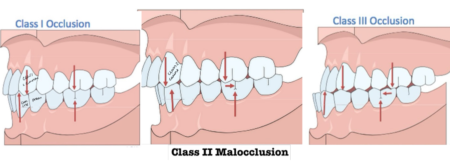 <p>Mesiobuccal cusp of upper 1st molar falls <strong>within</strong> vs in <strong>front</strong> of vs <strong>behind</strong> the Buccal groove of the lower 1st molar </p>