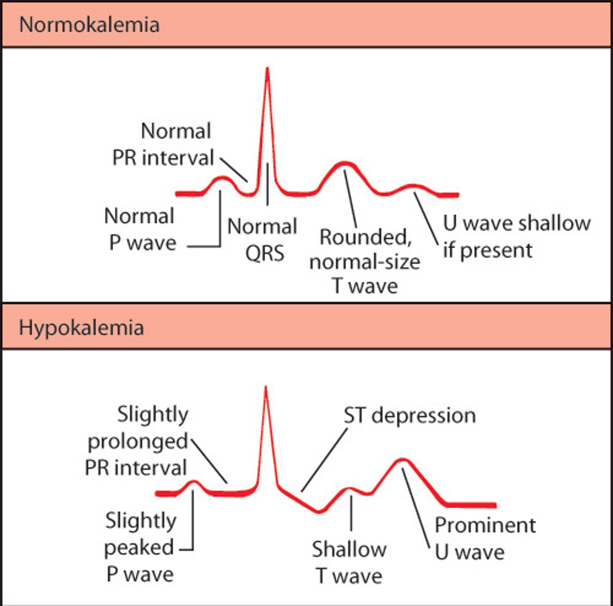 <p>Flattened or inverted T waves, the presence of U waves (a small wave appearing after the T wave), and possible ST segment depression</p>