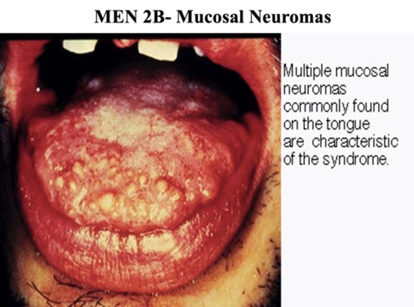 <p>MEN2B</p>