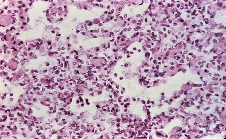 <p>Taken from a fetal lung of a sheep.</p><p>Name the predominant cell type seen in this slide (within the alveoli).</p>