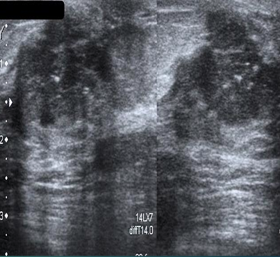 <p><span>Involves reddening, ulceration, eczema-like crusting of the epidermis of the nipple and areola</span></p>