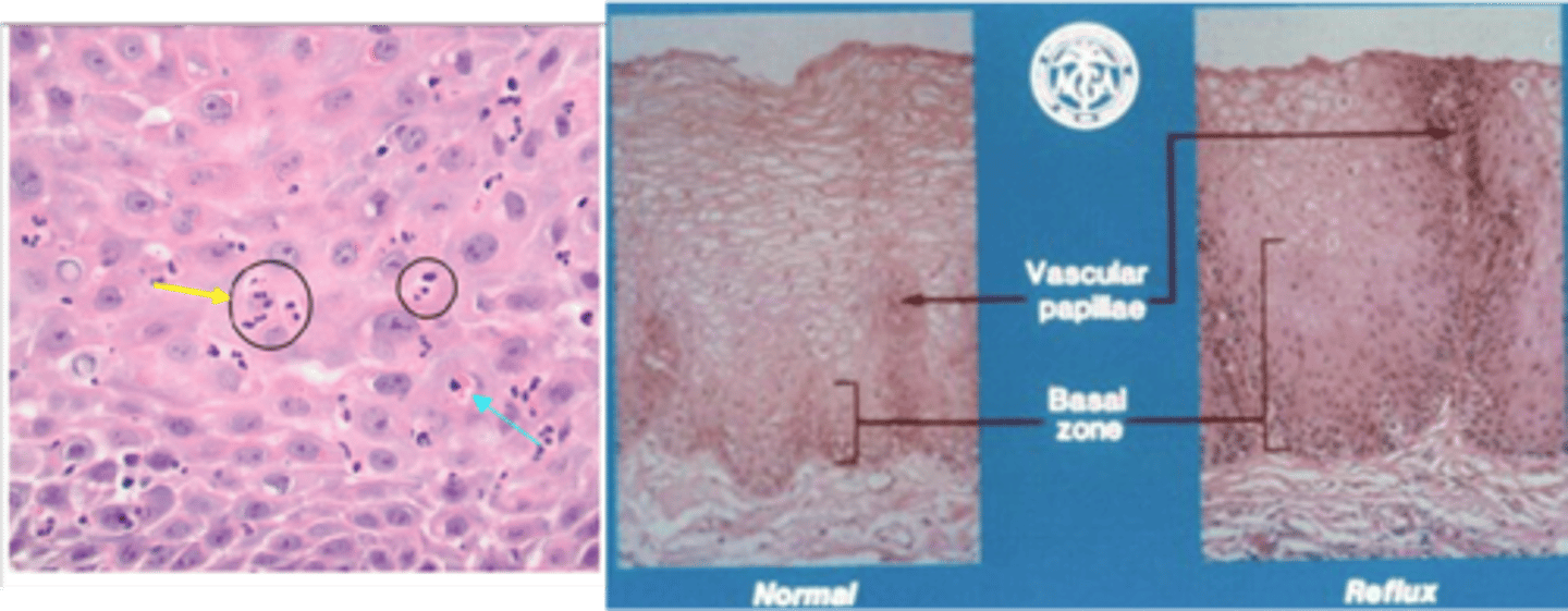 <p>Define Condition:</p><p>Reflux of gastric juices causing mucosal injury d/t transient decreases in lower esophageal sphincter (LES) tone</p><p>-Hx: Increase frequency of transient LES relaxations</p><p>&gt; Foods (Fat, Chocolate, Spicy)</p><p>&gt; Habits (EtOH, Caffeine, Smoking)</p><p>&gt; Obesity (stretching &amp; applied pressure to LES --&gt; less LES tone)</p><p>&gt; Hiatal Hernia</p><p>&gt;&gt; Changes GE Junction</p><p>&gt;&gt; Loosens LES</p><p>&gt;&gt; Increase transient LES relaxations</p><p>&gt; Pregnancy (prolongs intra-abdominal pressure)</p><p>-Sx:</p><p>&gt; Heartburn</p><p>&gt; Dysphagia</p><p>&gt; Regurgitation of Sour-tasting gastric contents</p><p>&gt; Asthma-like Sx (Aspiration of acid in trachea --&gt; Coughing, Wheezing, Pneumonia)</p><p>&gt; Retrosternal Chest Pain</p><p>-Dx:</p><p>&gt; Biopsy:</p><p>&gt;&gt; Eosinophils &amp; Neutrophils scattered in epithelium</p><p>&gt;&gt; HYPERPLASTIC on reflux side</p><p>-Prog: (most have no complications)</p><p>&gt; Erosive Esophagitis</p><p>&gt; Strictures</p><p>&gt; Barrett esophagus</p>