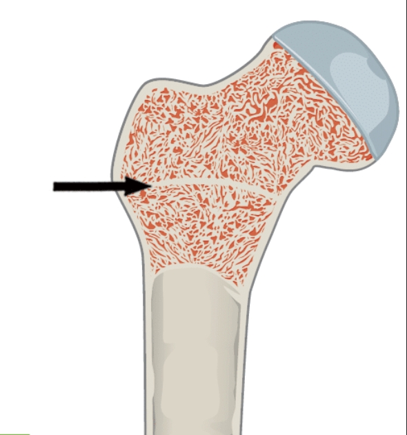 <p>A remnant of the growth plate found in mature bones, indicating where the epiphyseal plate was located during growth. </p>