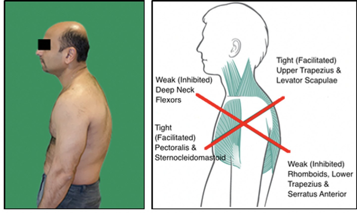 <p>Rationale</p><p>1. This is correct because the long thoracic extensors demonstrate a stretch weakness in this posture</p><p>2. This is incorrect because this patient would use this muscle chronically in its shorter range. Manual muscle testing done in its longer range would have a weaker than normal result. Manual muscle testing in its shorter range would result in a normal or slightly stronger than normal result. Muscle imbalances can occur when a patient strengthens the anterior pectoral muscles and ignores the upper back. This results in tight pectoral muscles and weak rhomboids and trapezius. (Shultz, p. 201)</p><p>3. The sternocleidomastoid has increased use during cervical extension (forward head). This muscle would demonstrate a short-strong muscle imbalance. (Hueter-Becker, p. 114)</p><p>4. This is incorrect because the suboccipital extensors are chronically in a shorter range. This muscle would demonstrate a short-strong muscle imbalance. (Hueter-Becker, p. 114)</p>
