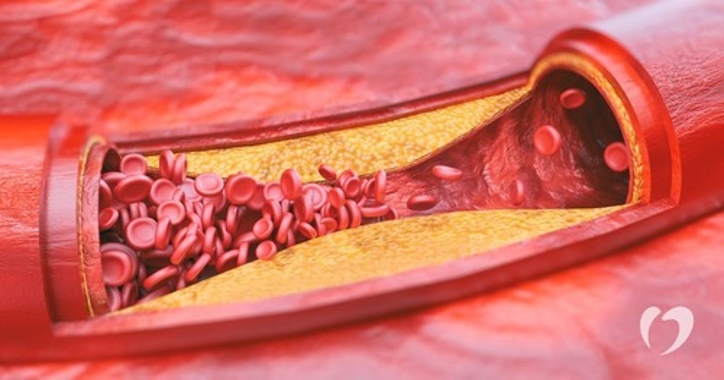 <p>Caused by buildup of plaque on interior walls of arteries</p>