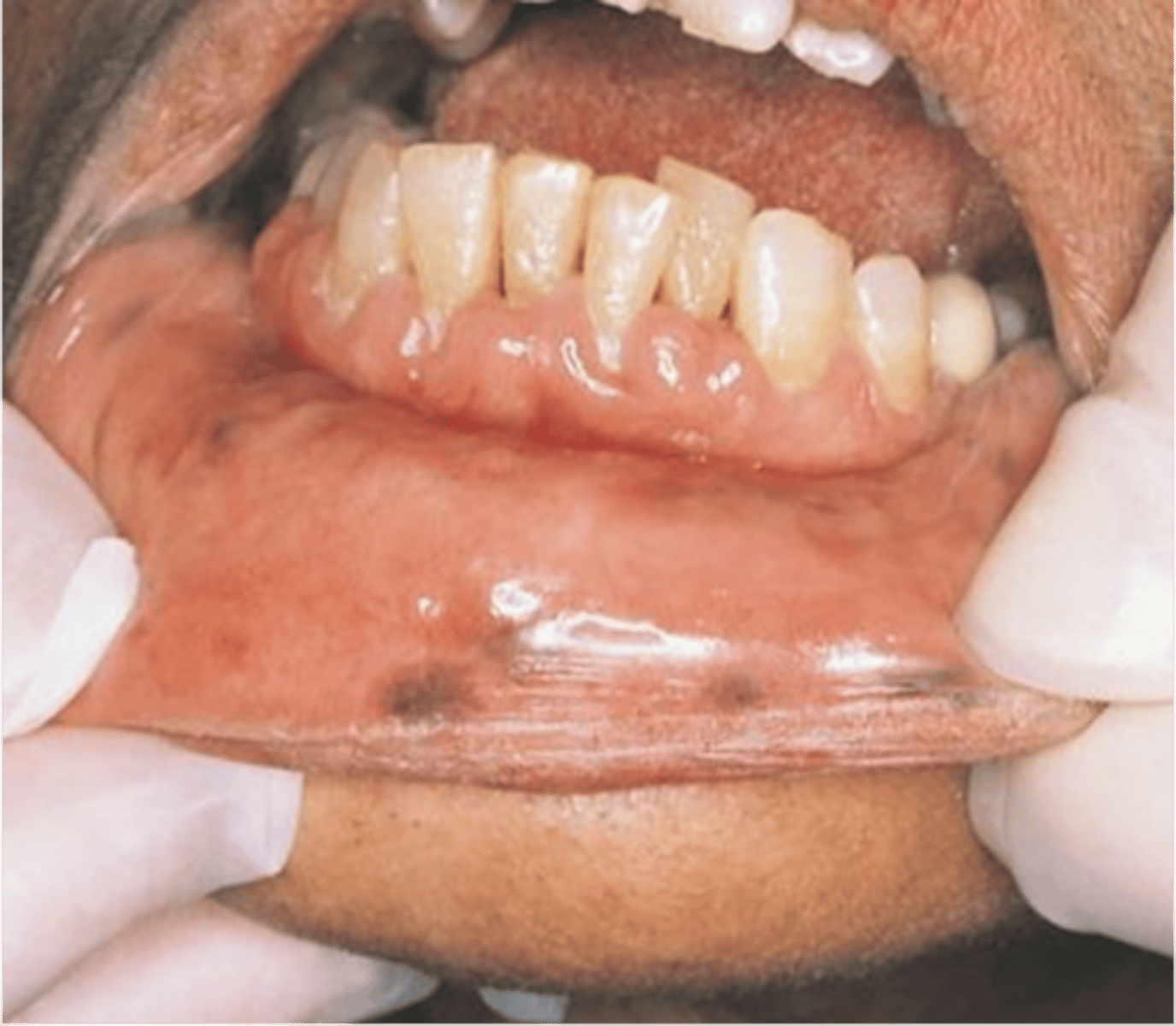 <p>mucosal pigmentation, associated with gastrointestinal polyposis.</p>