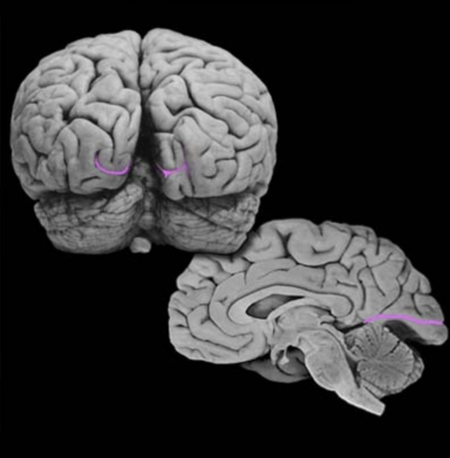 <p>Calcarine sulcus</p>