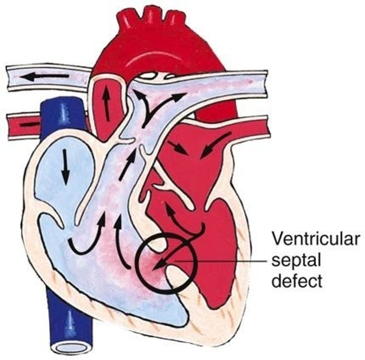 <p>hole between ventricles</p><p>- most common defect</p><p>- Causes left heart overload + pulmonary overload</p><p>- leads to early heart failure</p>