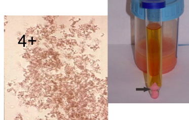 <p>Normal</p><ul><li><p>acidic urine</p></li><li><p>form upon refrigeration</p></li><li><p>pink sediment, brown/yellow/pink granule microscopically</p></li><li><p>heat and  sodium hydroxide (alkaline) soluble</p></li></ul><p></p>