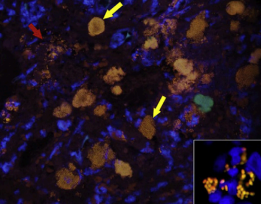 <p><span style="background-color: transparent;"><strong><span>E. coli Granulomatous Colitis</span></strong></span></p>