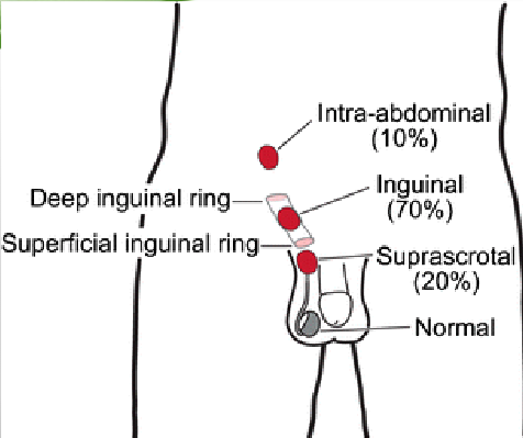 <p>inguinal canal</p>