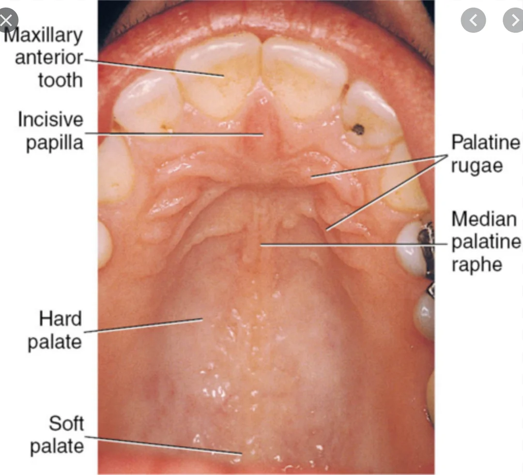 <p><strong>Median palatine raphe: </strong>A midline ridge running along the hard palate, from the incisive papilla to the uvula.</p><p><strong>Formation:</strong></p><ul><li><p>Formed when the lateral palatine shelves (from the maxillary processes) <strong>fuse at the midline</strong> during secondary palate development.</p></li><li><p>The line of fusion becomes the median palatine raphe, covered by mucosa.</p></li></ul><p></p>