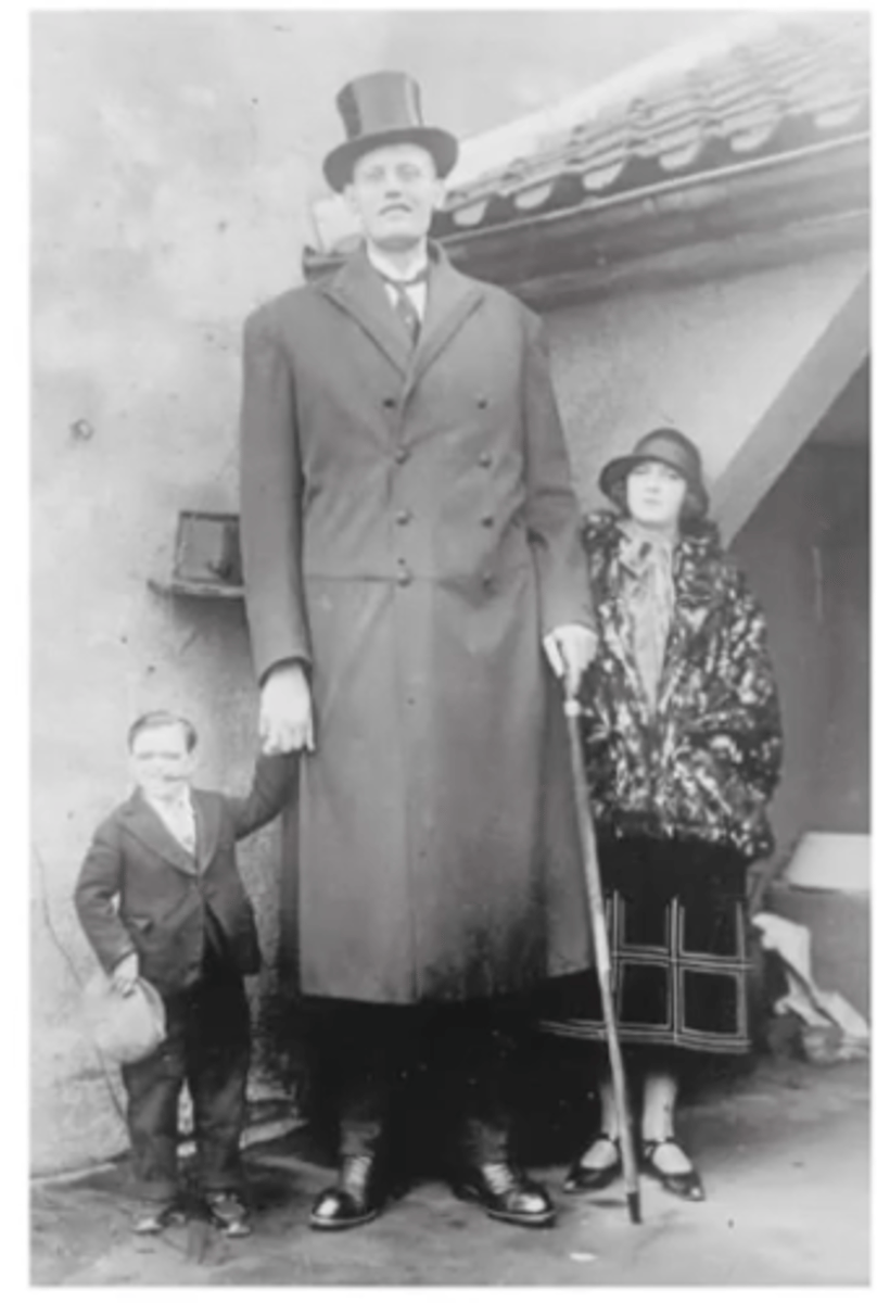 <p>gigantism, results in adulthood of acromegaly</p>