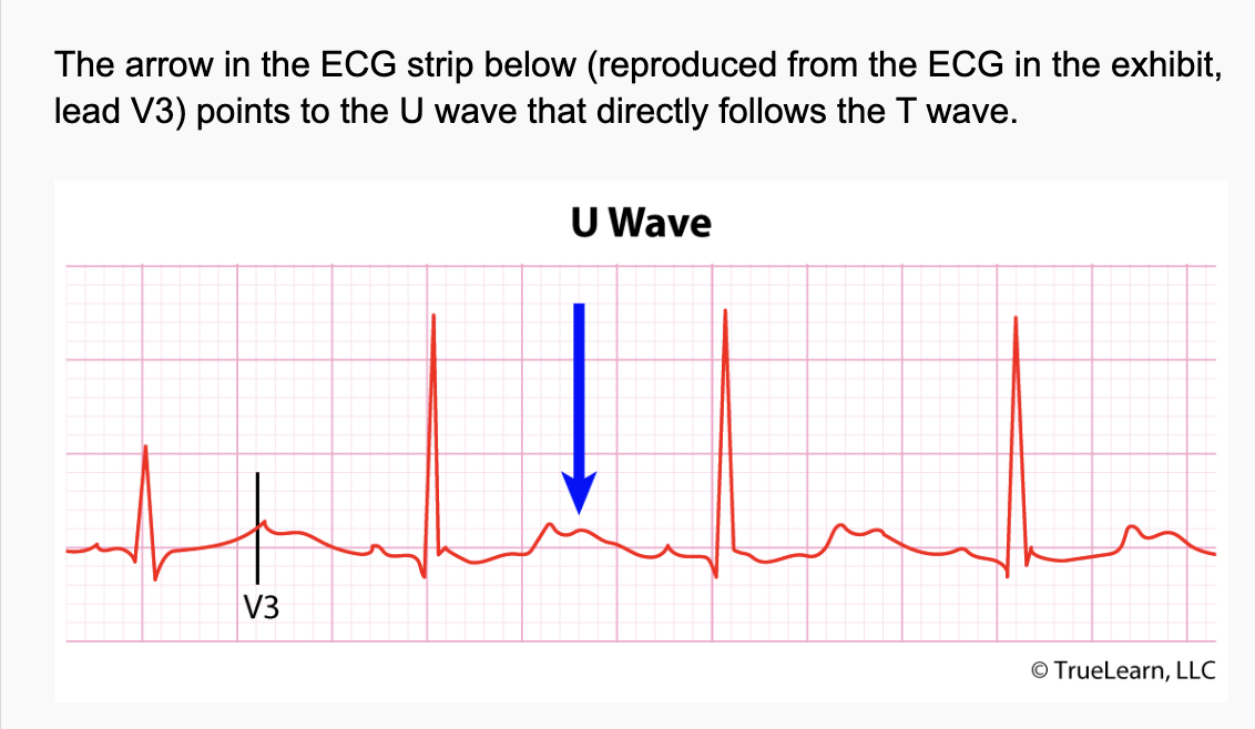 <p>Potassium is vital for regulating the normal electrical activity of the heart. Decreased extracellular potassium causes myocardial hyperexcitability with the potential to develop re-entrant arrhythmias. Severe Hypokalemia can lead to flaccid paralysis, muscle weakness, fatigue, muscle cramps, rhabdomylisis, and arrhythmias.</p>