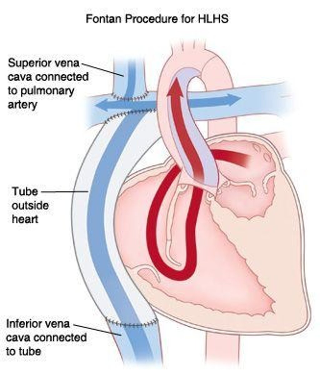<p>3rd stage of HLHS correction; the IVC is connected to the pulmonary arteries. This closes the circuit &amp; results in only deoxygenated blood travelling to the lungs &amp; only oxygenated blood travelling to the body</p>