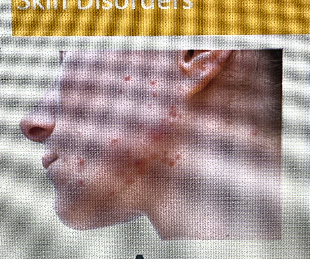 <p>SKIN DISORDER</p><p>acne</p>