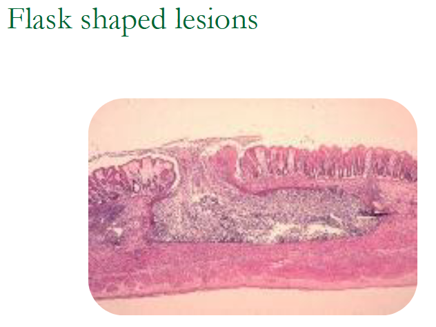<ul><li><p><span>Amoebas eat into intestinal tissues</span></p></li><li><p><span><u>Form flask shaped ulcers</u></span></p></li><li><p><span>Can perforate the intestine</span></p></li><li><p><span><u>Stools consist of blood and mucus--eats RBCs</u></span></p></li><li><p><span>"pot bound"</span></p></li><li><p><span>No fever</span></p></li></ul><p></p>