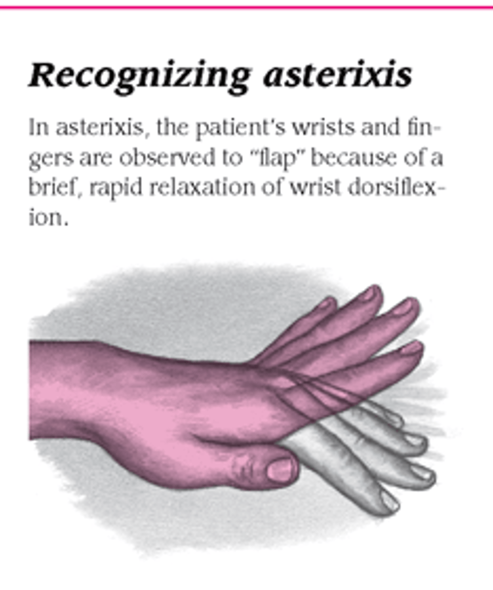 <p>flapping tremors of the hands<br>to assess, have pt extend the arms and dorsiflex the wrist</p>