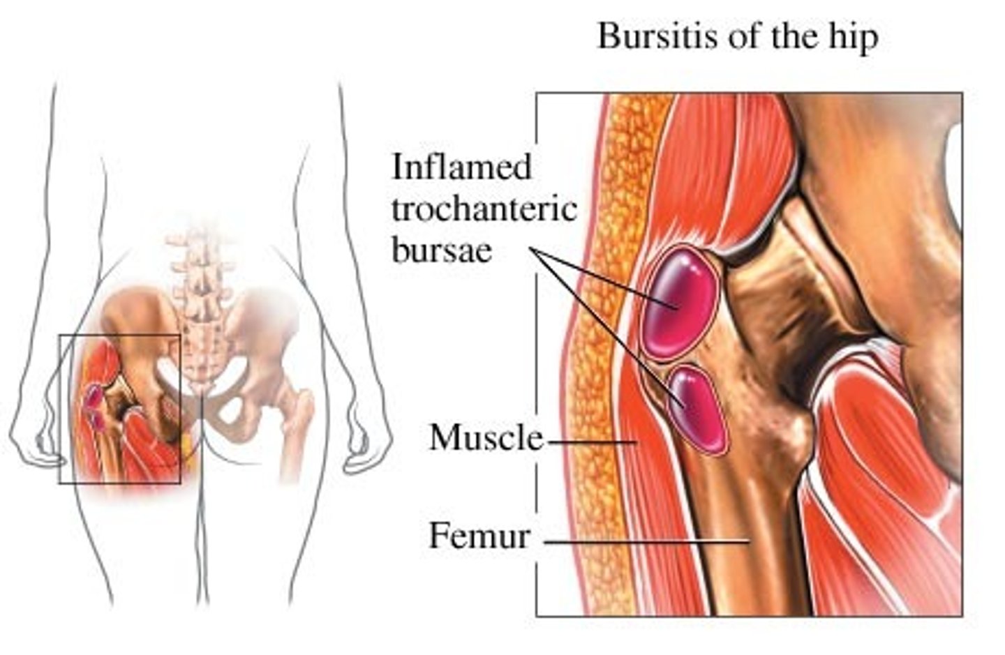 <p>Trochanteric bursitis </p><p>Common cause of hip pain in middle-aged women </p>