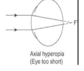 <p>refractive components focus light where the retina should be </p><p>but eye length is too small </p><p>eye too short so light rays converge fruther from the retina as retina i scloser than where the light rays naturally converge&nbsp;</p>