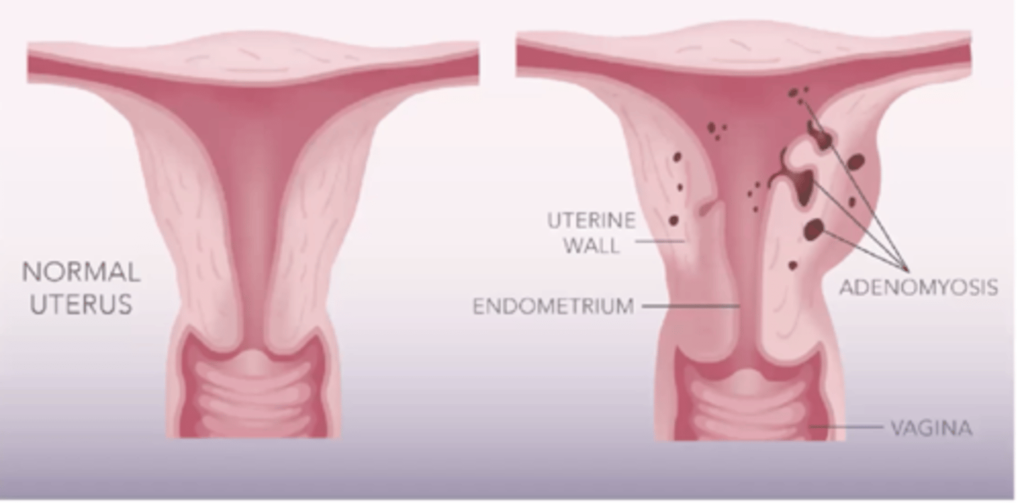 <p>Endometrial tissue found within the myometrium</p>