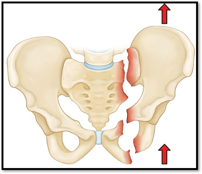 <p><span>•Uncommon, high mortality</span></p><p><span>•</span><strong><u><span>Signs/Symptoms: </span></u></strong><span>localized swelling, tenderness, deformity, unusual pelvic movement, ecchymosis</span></p><p><span>•</span><strong><u><span>Complications: </span></u></strong><span>intraabdominal injury, compartment syndrome</span></p><p><span>•</span><strong><u><span>Diagnostics: </span></u></strong><span>Xray, CT</span></p><p><span>•</span><strong><u><span>Treatment: </span></u><em><span>Non-displaced- </span></em></strong><span>bedrest, early mobilization. </span><strong><em><span>Complex</span></em></strong><span>- pelvic sling, traction, external fixation, open reduction. </span><strong><em><span>Displaced</span></em></strong><span>- ORIF (open reduction internal fixation)</span></p><p><strong><u><span>Nursing Care: </span></u></strong><span>Use trapeze for assistance, turn patient only when ordered, assess bowel</span></p>