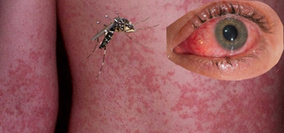 <p><strong>Conjunctivitis</strong>, headache, retro-orbital pain, fever, malaise, arthralgia, and rash.</p>