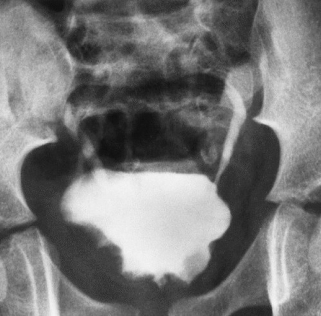 <p>- What refers to the inflammation of the bladder caused by feces entering the bladder or a nosocomial infection after being catheterized?</p><p>- What sex does this commonly occur in?</p><p>- When moving a patient, where should their catheter be kept?</p><p>- What is seen radiographically, if this infection is causing chronic damage?</p>