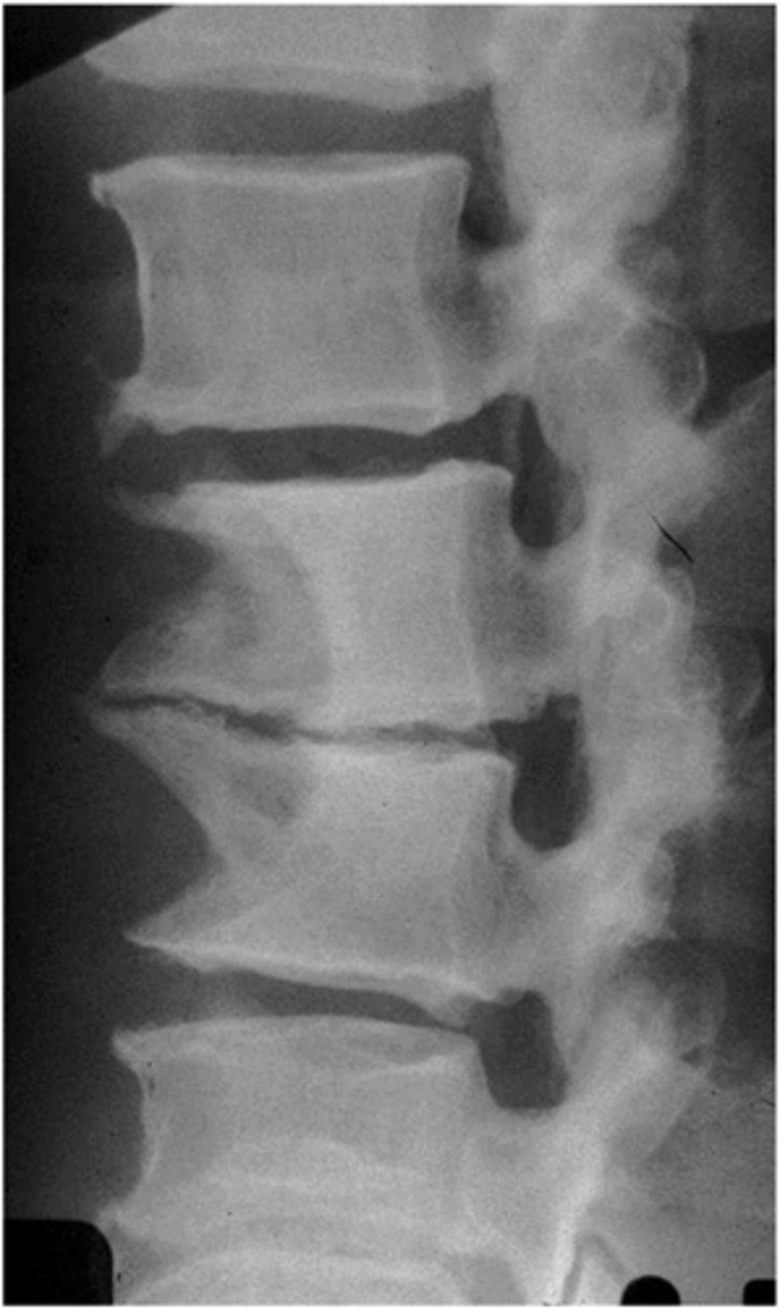 <p>spondylosis</p>