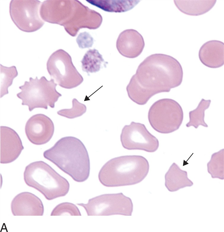 <p>what is a schistocyte (RBC fragment)?</p>