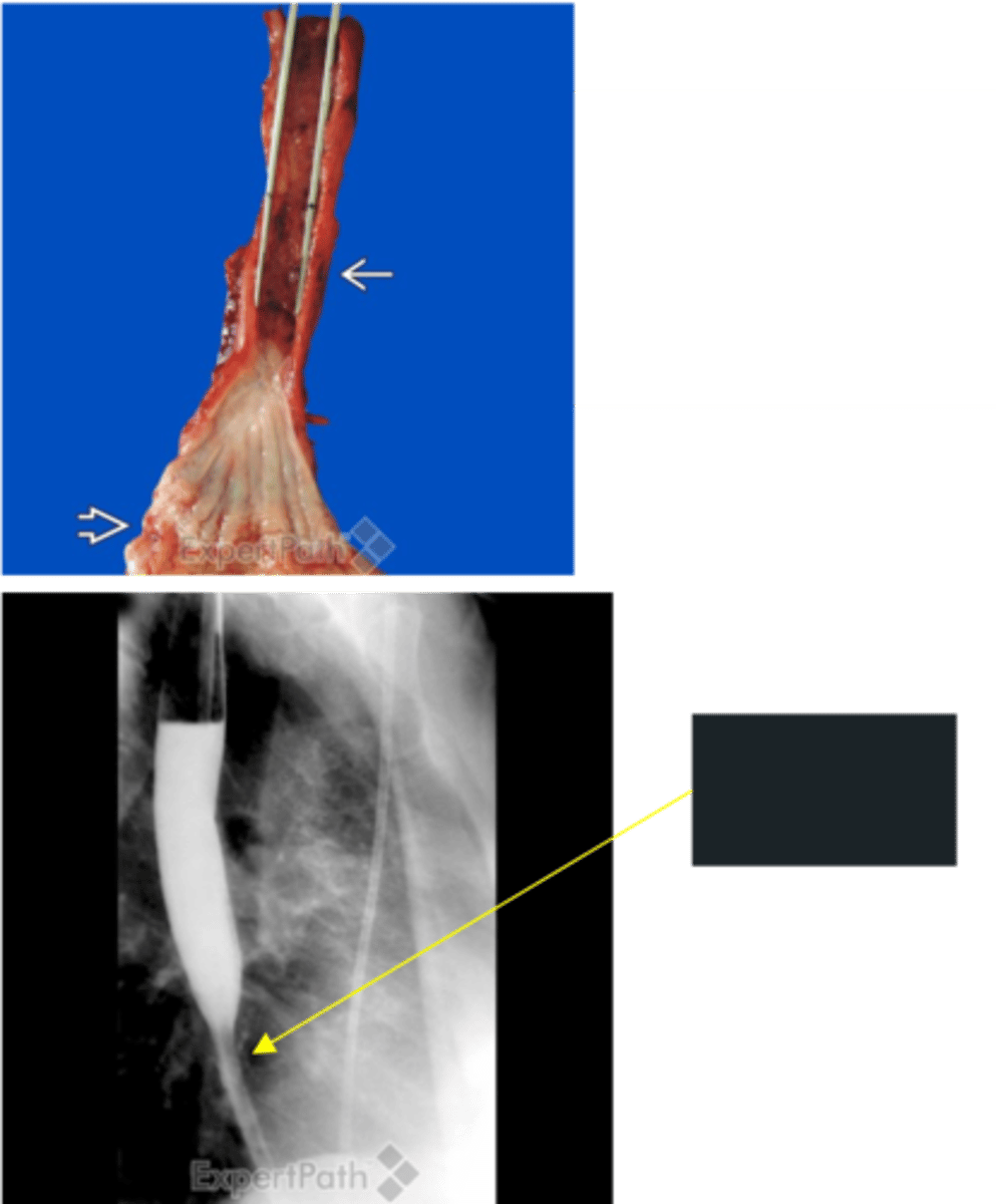 <p>Define Condition:</p><p>Fibrous thickening of the submucosa and atrophy of the muscularis propria​</p><p>-Hx:</p><p>&gt; MCC = Chronic GERD</p><p>&gt; Irradiation</p><p>&gt; Ingestion of Caustic Agents</p><p>-Sx:</p><p>&gt; Progressive Dysphagia of Solids --&gt; Liquids</p><p>-Dx: ALWAYS BIOPSY (may result from infiltrating carcinoma - may be malignant)</p>