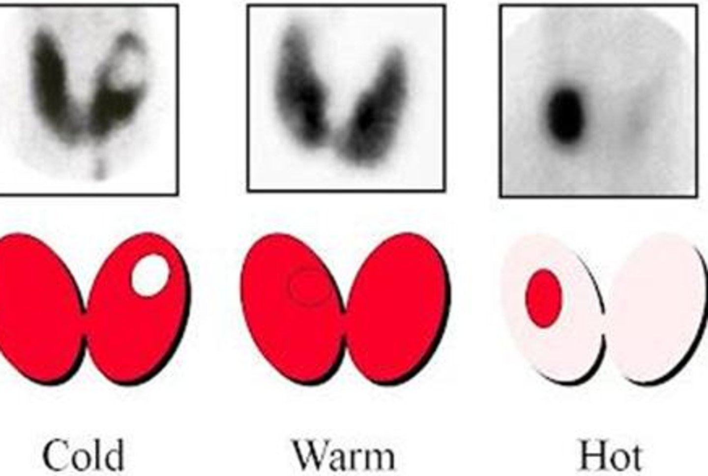 <p>Increased uptake --&gt; sign of Graves/toxic multinodular goiter</p>