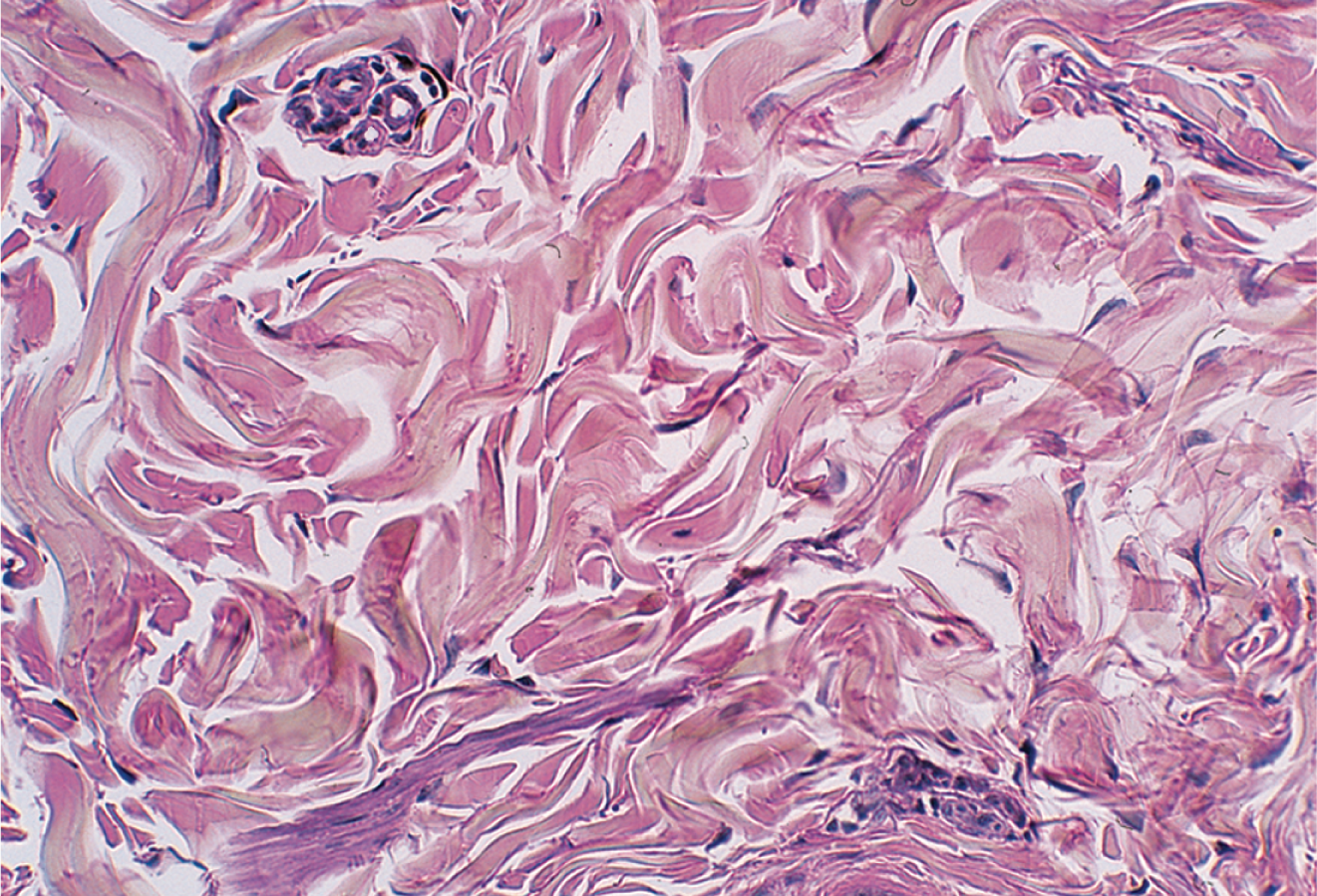 <p>Densely packed, randomly arranged collagen fibers; withstand unpredictable stresses; found in deep layers of the skin and capsules around organs </p>
