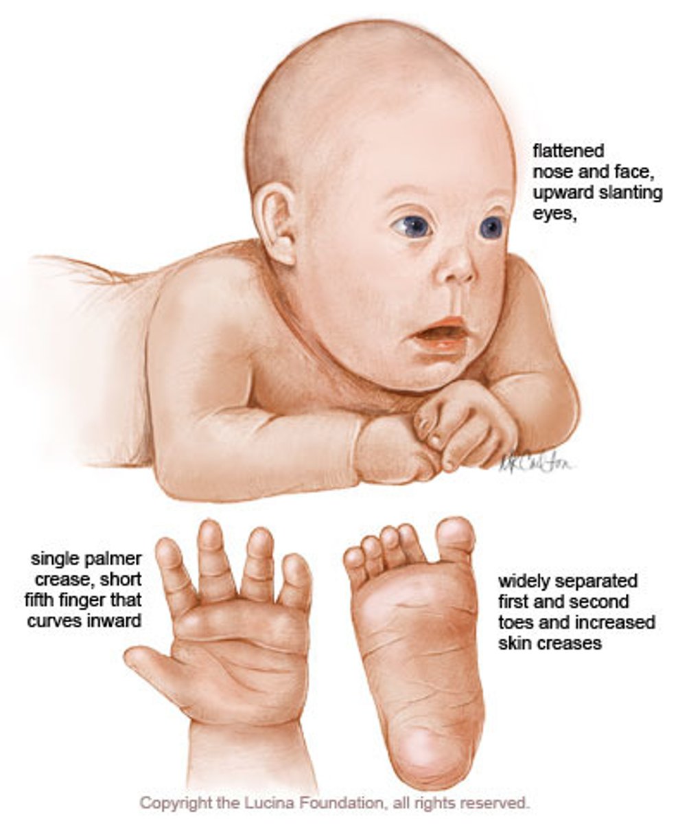 <p>Trisomy 21 (Down Syndrome)</p>