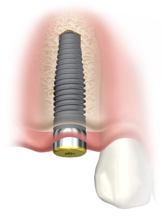 <p>Why do you have to place impression coping immediately?</p>