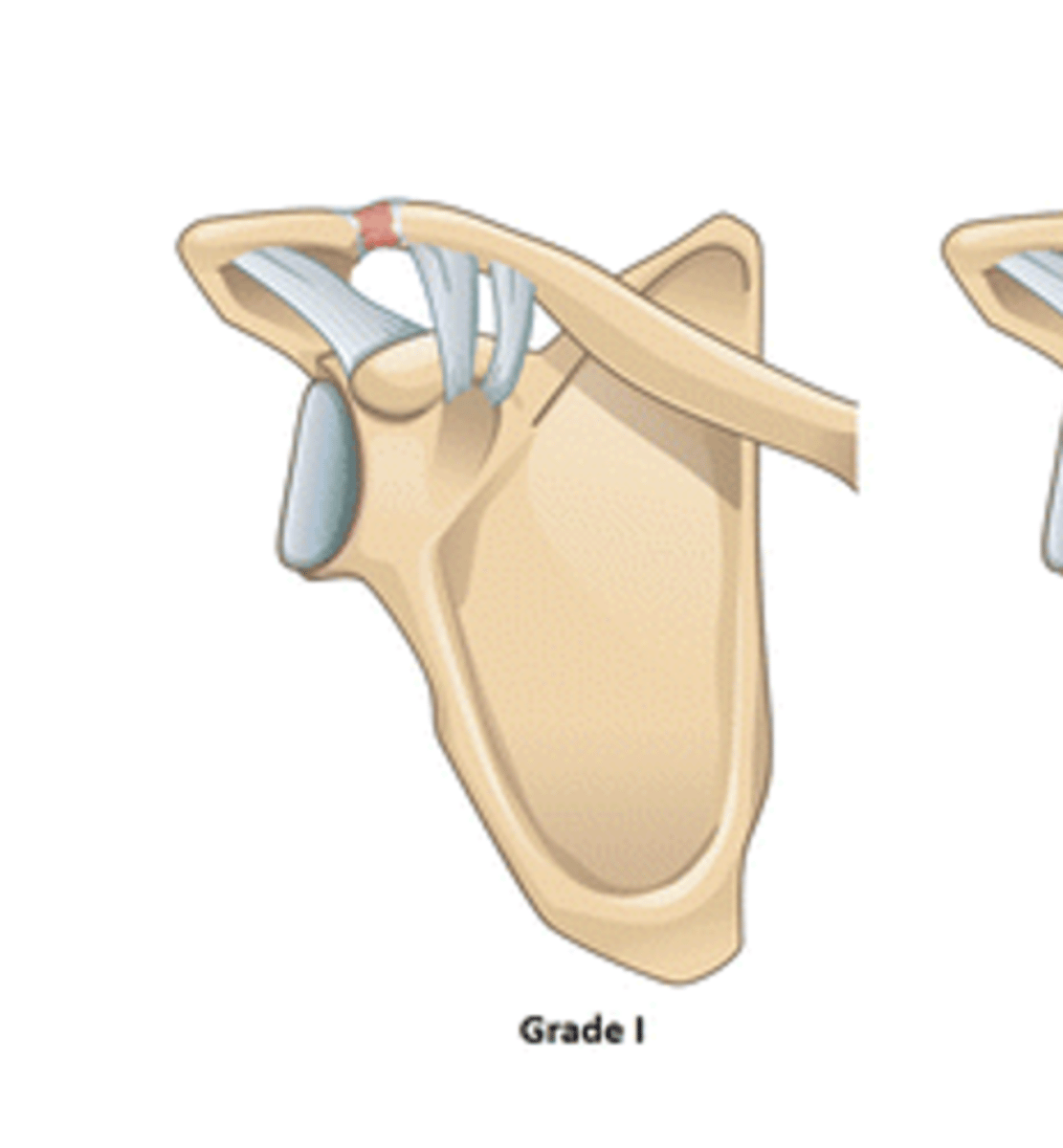 <p>According to the Rockwood Classification System, a grade I ACJ separation entails: __________</p>