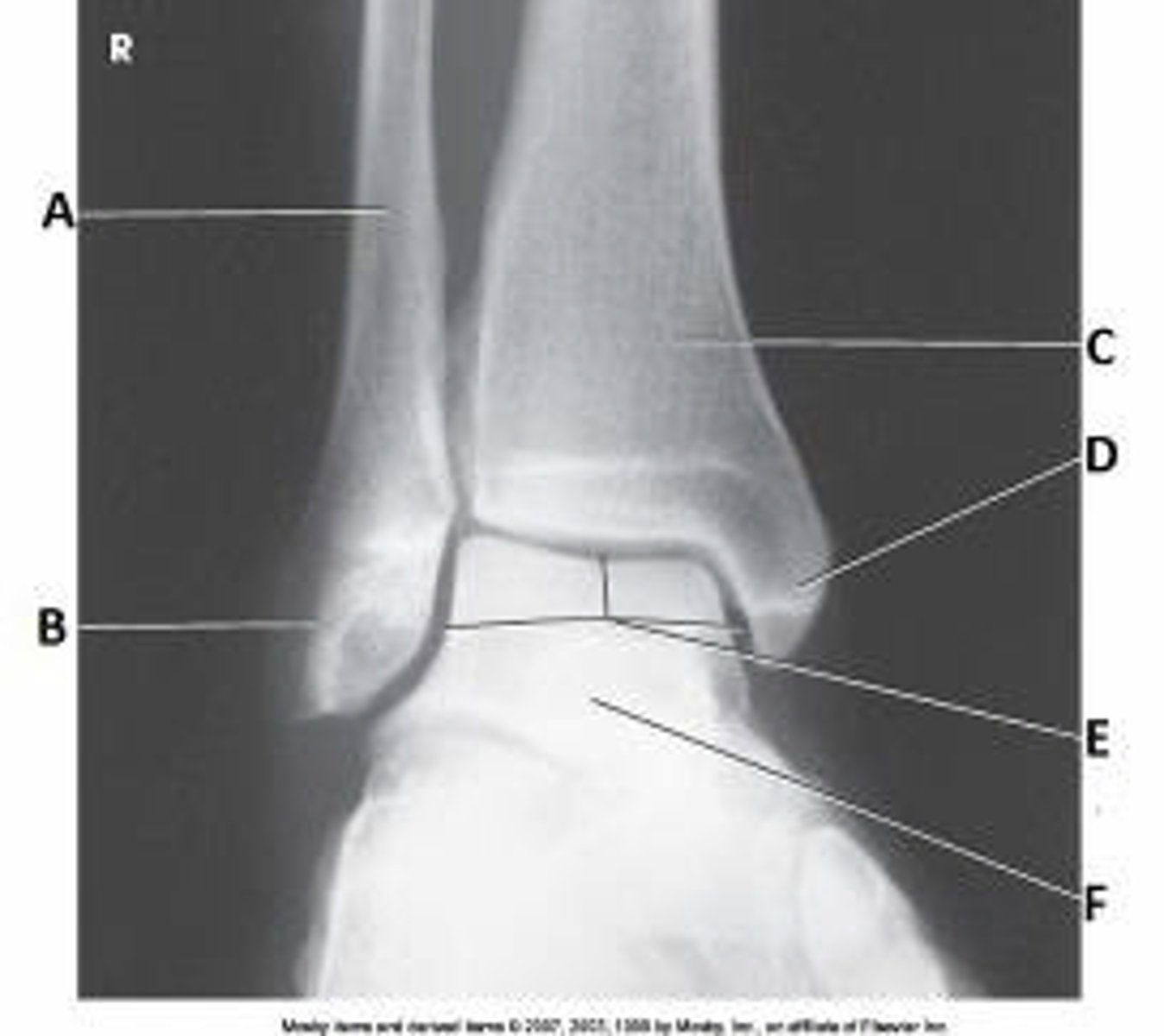 <p>What anatomy is labeled as letter E in the image below?</p><p>Sinus tarsi</p><p>Tibiotalar joint</p><p>Mortise joint</p><p>Medial malleolus</p>