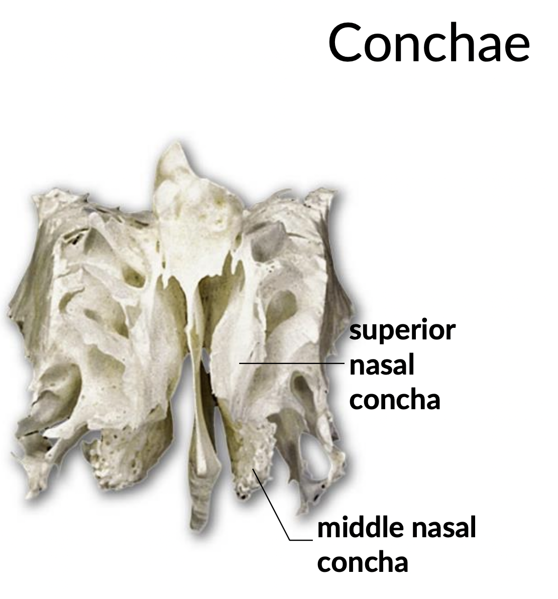 What facial bones is this?