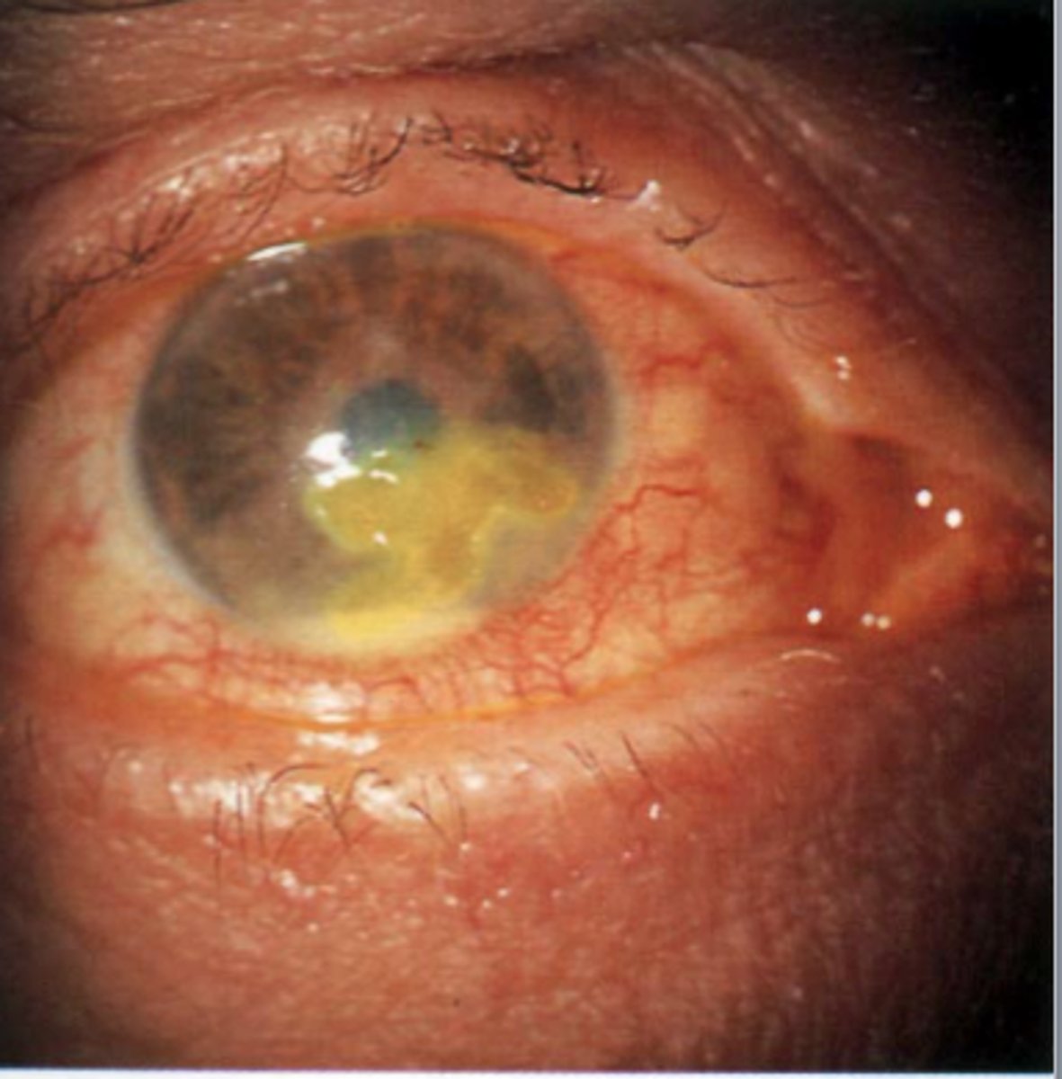 <p>Caused by herpes simplex virus 1 (HSV-1)</p><p>Infects cornea and may cause blindness</p>