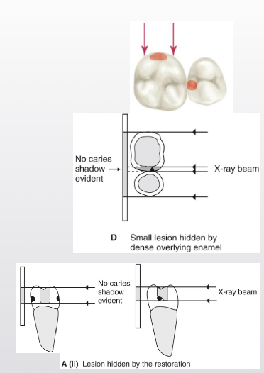 <ul><li><p><span style="color: #000000">Degree of radiolucency is determined by extent of caries in <strong>buccolingual plane</strong></span></p></li><li><p><span style="color: #000000">Caries depth relative to pulp</span></p><ul><li><p><span style="color: #000000">Appearance of exposure could be result of superimposition</span></p></li></ul></li><li><p><span style="color: #000000">Small amount of demineralization may not be visible</span></p><ul><li><p><span style="color: #000000">Tooth with broad contact does not show caries as well – greater density of tooth structure surrounding caries</span></p></li></ul></li><li><p><span style="color: #000000">True depth of lesion often greater than visible on image</span></p></li></ul><p></p>
