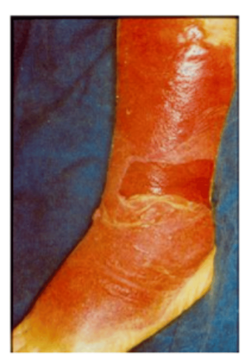 <p>Progressing follicle infection with very redding of skin</p><p>-Strep pyogenes</p>