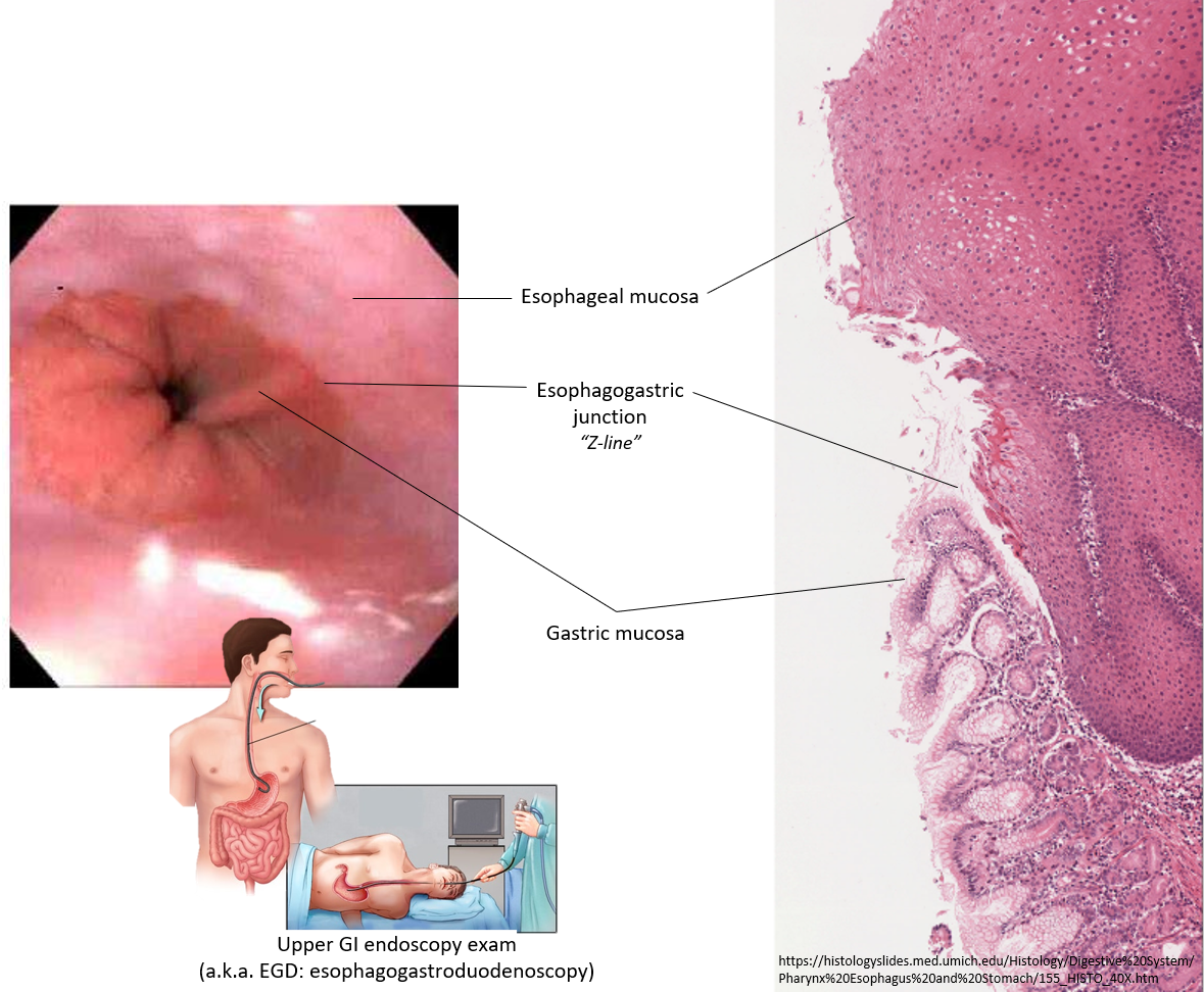 <p>Where the esophagus connects to the stomach.</p><p>The <strong>Z-line</strong> marks the spot where the lining of the esophagus changes to the stomach lining.</p>